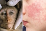 Viruela del Mono: cuáles son los síntomas y cómo se contagia
